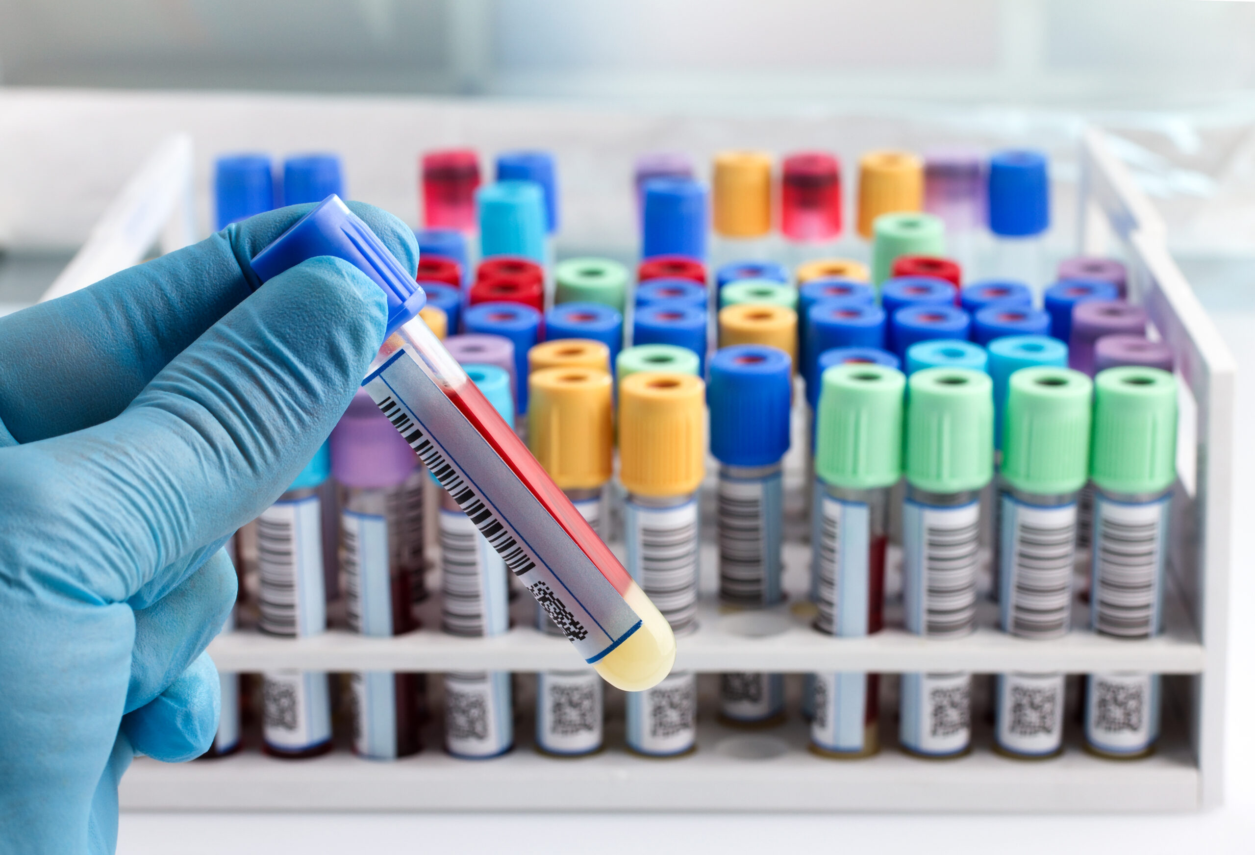 laboratory technician holding a blood tube test labeled with bar hand of a lab technician holding blood tube test and background a rack of color tubes with blood samples other patients / laboratory technician holding a blood tube test with code bar